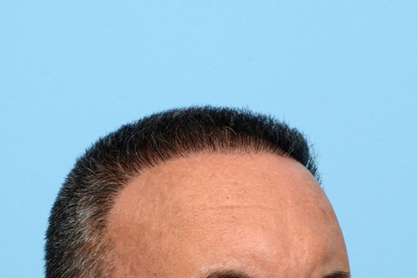 Fue Before and After | Dr. Jeffrey Wise