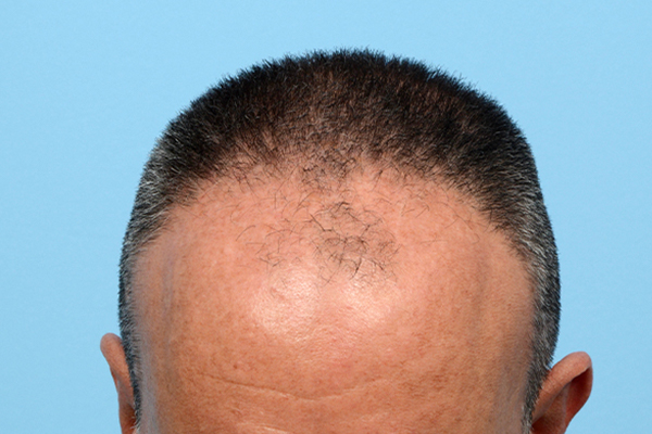 Fue Before and After | Dr. Jeffrey Wise