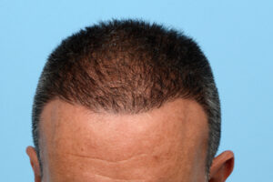 Fue Before and After | Dr. Jeffrey Wise