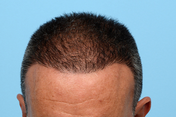 Fue Before and After | Dr. Jeffrey Wise