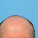 Fue Before and After | Dr. Jeffrey Wise