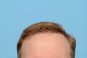 Fue Before and After | Dr. Jeffrey Wise