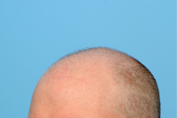 Fue Before and After | Dr. Jeffrey Wise