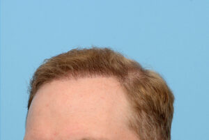 Fue Before and After | Dr. Jeffrey Wise