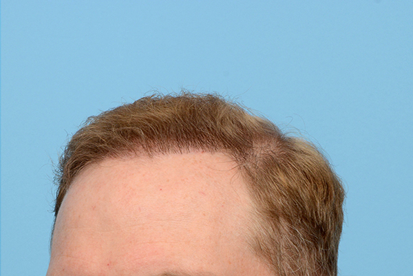 Fue Before and After | Dr. Jeffrey Wise