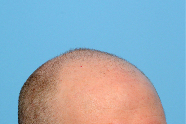 Fue Before and After | Dr. Jeffrey Wise