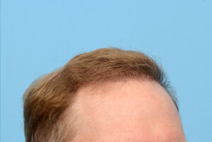 Fue Before and After | Dr. Jeffrey Wise