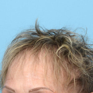 Fut Patient 12 After