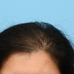 Fut Patient 13 After