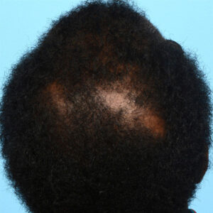 Fut Patient 14 Before