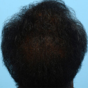 Fut Patient 14 After