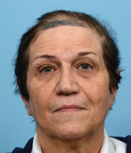 Fut Patient 15 Before