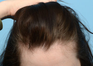 Fut Patient 16 Before