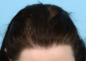 Fut Patient 16 After