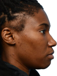 Fut Patient 18 Before