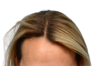 Fut Patient 19 Before