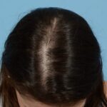 Prp Before and After | Dr. Jeffrey Wise