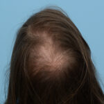 Prp Before and After | Dr. Jeffrey Wise