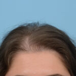Prp Before and After | Dr. Jeffrey Wise