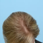 Prp Before and After | Dr. Jeffrey Wise