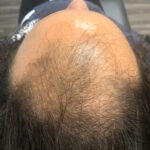 Prp Before and After | Dr. Jeffrey Wise