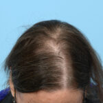 Prp Before and After | Dr. Jeffrey Wise
