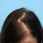 Prp Before and After | Dr. Jeffrey Wise