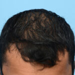 Prp Before and After | Dr. Jeffrey Wise