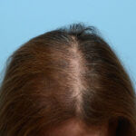 Prp Before and After | Dr. Jeffrey Wise