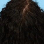 Prp Before and After | Dr. Jeffrey Wise