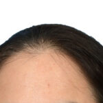 Prp Before and After | Dr. Jeffrey Wise