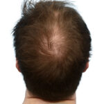 Prp Before and After | Dr. Jeffrey Wise