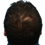 Prp Before and After | Dr. Jeffrey Wise