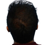 Prp Before and After | Dr. Jeffrey Wise