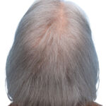 Prp Before and After | Dr. Jeffrey Wise