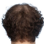 Prp Before and After | Dr. Jeffrey Wise