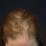 Prp Before and After | Dr. Jeffrey Wise