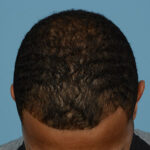 Prp Before and After | Dr. Jeffrey Wise