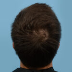 Prp Before and After | Dr. Jeffrey Wise