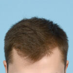 Prp Before and After | Dr. Jeffrey Wise