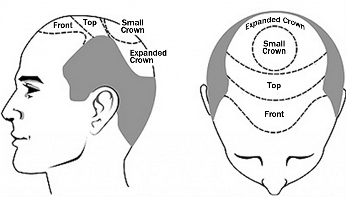 Hair Restoration Zones